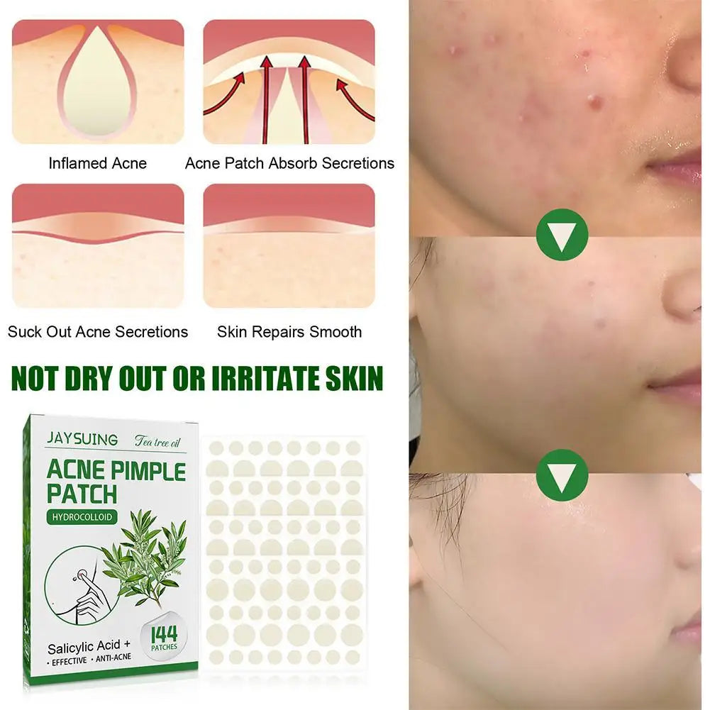 144 ACNE PIMPLE PATCHES Translucent Matte Hydrocolloid Salicylic Acid Tea Tree Oil For Inflamed Acne Improve Whiteheads